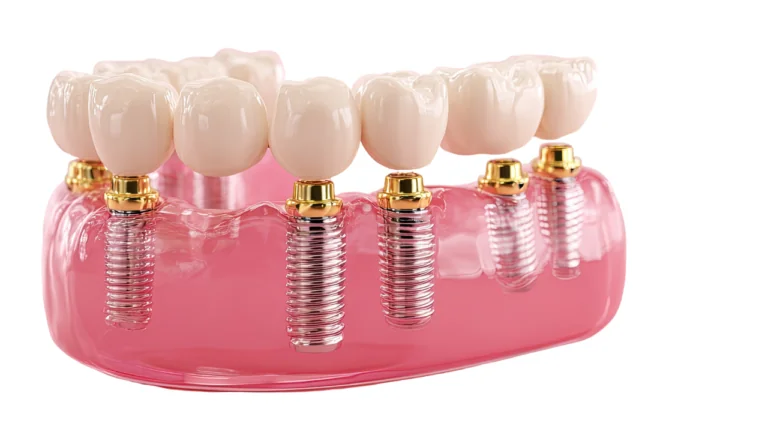 Implanty Dentystyczne All-on-6: Mocniejsze wsparcie, dłuższa żywotność